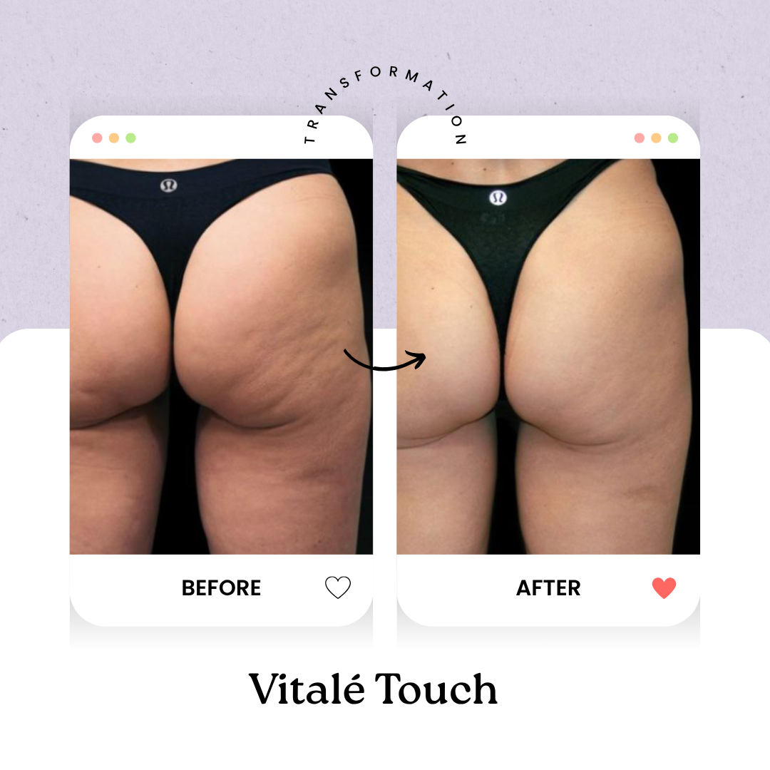 Vitalé Touch Anti-Cellulite Massager
