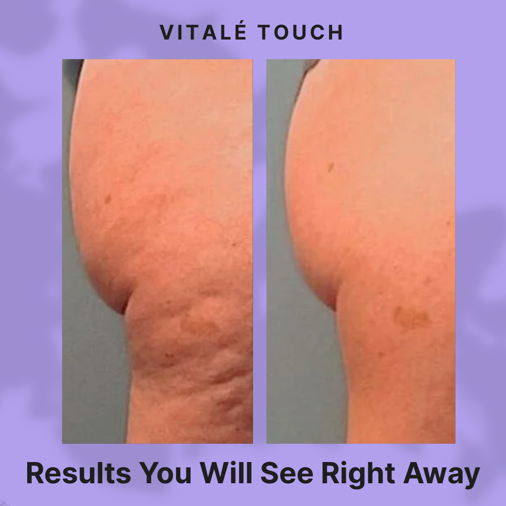 Vitalé Touch Anti-Cellulite Massager