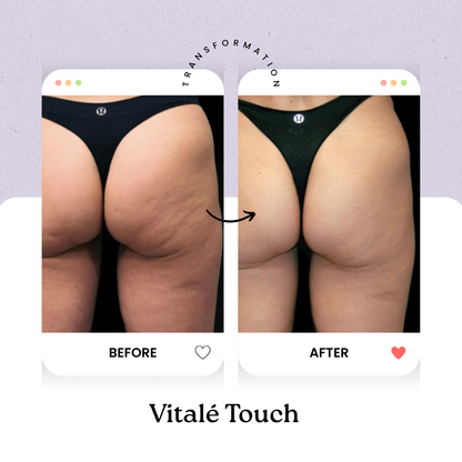 Vitalé Touch Anti-Cellulite Massager